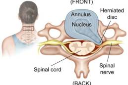 Perth Wellness Centre Blogs - How to treat a Herniated Disc