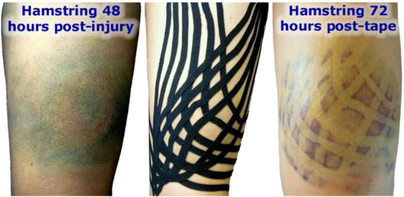Effect of Kinesiology Fan Taping on Swelling and Bruising - Blog Post