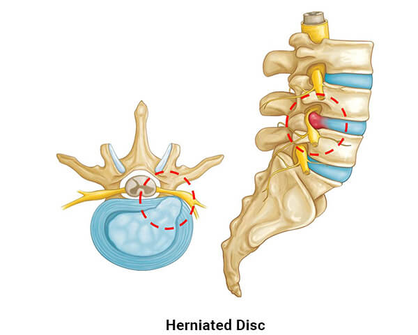 Perth Wellness Centre - 요추 추간판 탈출증 - Lumbar Disc Herniation
